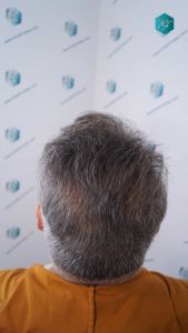 Injerto Capilar Técnica FUE Grafts 3712 (7455 Pelos) 100 111 RESULTADOS A LOS 12 MESES