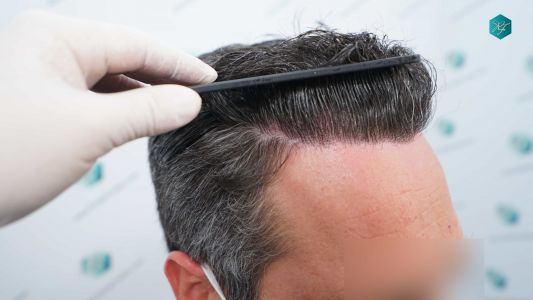 Injerto Capilar Técnica FUE Grafts 3289 (8464 Pelos) 32 111AA 12 MESES EVOLUCION