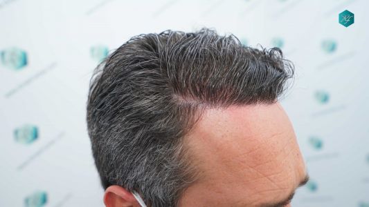 Injerto Capilar Técnica FUE Grafts 3289 (8464 Pelos) 33 111AB 12 MESES EVOLUCION