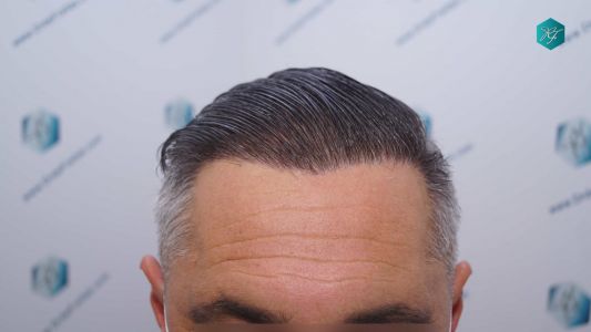 Injerto Capilar Técnica FUE Grafts 3712 (7455 Pelos) 101 112 RESULTADOS A LOS 12 MESES
