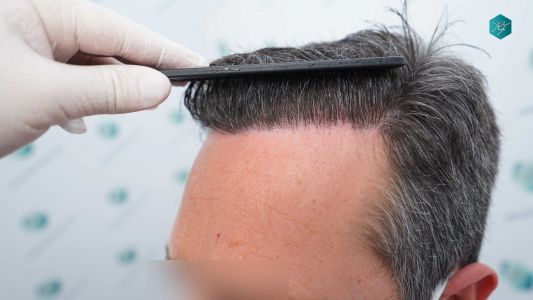 Injerto Capilar Técnica FUE Grafts 3289 (8464 Pelos) 34 112A 12 MESES EVOLUCION