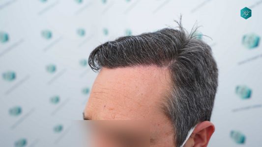 Injerto Capilar Técnica FUE Grafts 3289 (8464 Pelos) 35 112AB 12 MESES EVOLUCION