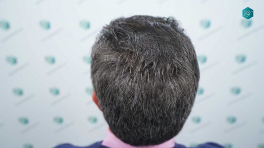Injerto Capilar Técnica FUE Grafts 3289 (8464 Pelos) 36 113 12 MESES EVOLUCION