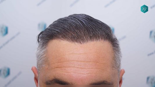Injerto Capilar Técnica FUE Grafts 3712 (7455 Pelos) 102 113 RESULTADOS A LOS 12 MESES