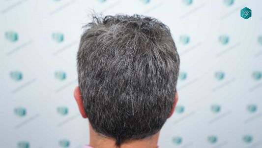 Injerto Capilar Técnica FUE Grafts 3289 (8464 Pelos) 37 114 12 MESES EVOLUCION