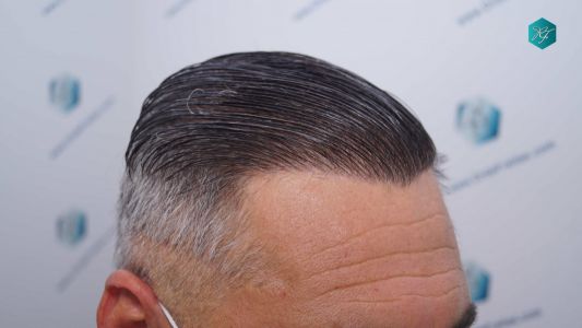 Injerto Capilar Técnica FUE Grafts 3712 (7455 Pelos) 103 114A RESULTADOS A LOS 12 MESES