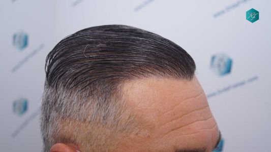 Injerto Capilar Técnica FUE Grafts 3712 (7455 Pelos) 104 114AB RESULTADOS A LOS 12 MESES