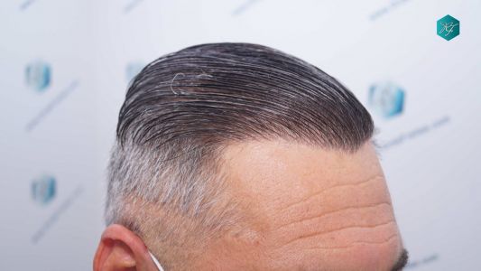 Injerto Capilar Técnica FUE Grafts 3712 (7455 Pelos) 105 114ABC RESULTADOS A LOS 12 MESES