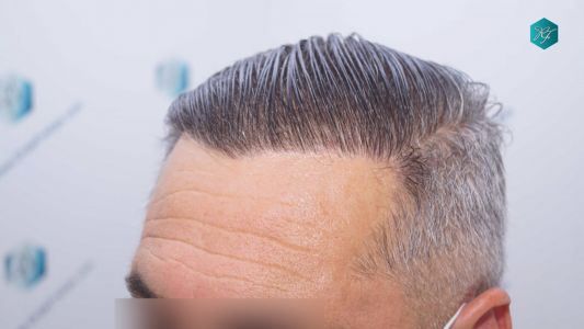 Injerto Capilar Técnica FUE Grafts 3712 (7455 Pelos) 106 114BB RESULTADOS A LOS 12 MESES
