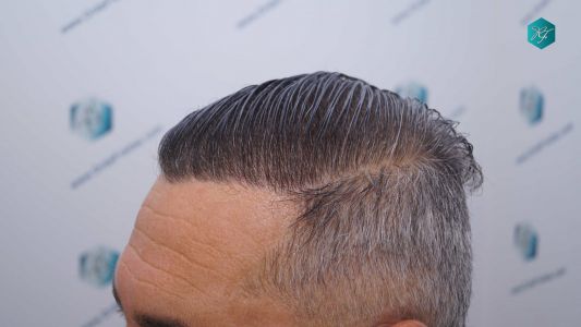 Injerto Capilar Técnica FUE Grafts 3712 (7455 Pelos) 107 114BC RESULTADOS A LOS 12 MESES