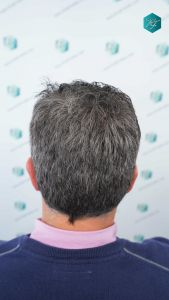 Injerto Capilar Técnica FUE Grafts 3289 (8464 Pelos) 38 115 12 MESES EVOLUCION