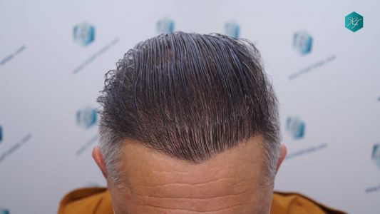 Injerto Capilar Técnica FUE Grafts 3712 (7455 Pelos) 108 119 RESULTADOS A LOS 12 MESES