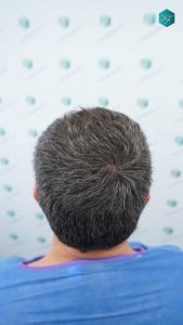Injerto Capilar Técnica FUE Grafts 3289 (8464 Pelos) 6 11A ANTES DEL TRASPLANTE CAPILAR