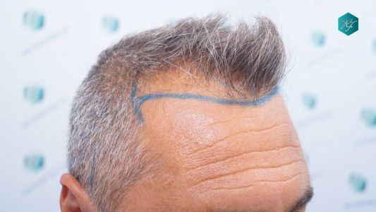 Injerto Capilar Técnica FUE Grafts 3712 (7455 Pelos) 10 11A DISENO LINEA DE INJERTO