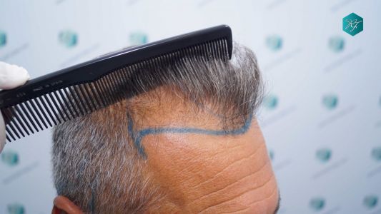 Injerto Capilar Técnica FUE Grafts 3712 (7455 Pelos) 11 11AA DISENO LINEA DE INJERTO