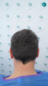 Injerto Capilar Técnica FUE Grafts 3289 (8464 Pelos) 7 11B ANTES DEL TRASPLANTE CAPILAR
