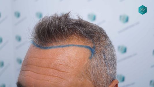 Injerto Capilar Técnica FUE Grafts 3712 (7455 Pelos) 12 11B DISENO LINEA DE INJERTO