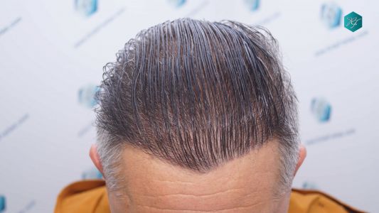 Injerto Capilar Técnica FUE Grafts 3712 (7455 Pelos) 109 120 RESULTADOS A LOS 12 MESES