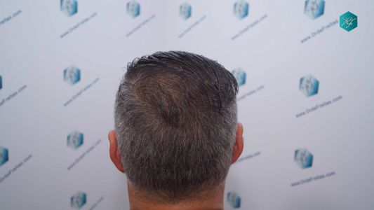 Injerto Capilar Técnica FUE Grafts 3712 (7455 Pelos) 110 121 RESULTADOS A LOS 12 MESES