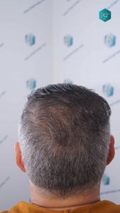 Injerto Capilar Técnica FUE Grafts 3712 (7455 Pelos) 111 122 RESULTADOS A LOS 12 MESES