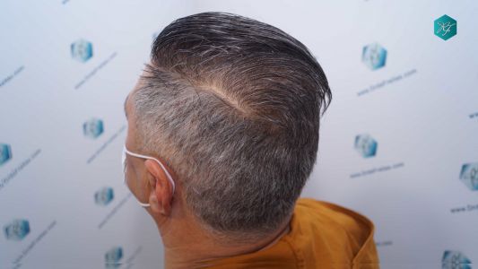 Injerto Capilar Técnica FUE Grafts 3712 (7455 Pelos) 112 123 RESULTADOS A LOS 12 MESES