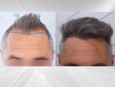 ANTES Y DESPUES TRASPLANTE DE PELO 124 COMPARATIVAS X