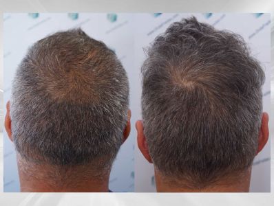 Injerto Capilar Técnica FUE Grafts 3712 (7455 Pelos) 113 125 COMPARATIVAS X