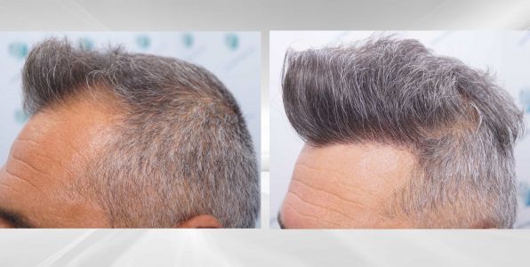 Injerto Capilar Técnica FUE Grafts 3712 (7455 Pelos) 114 126 COMPARATIVAS X