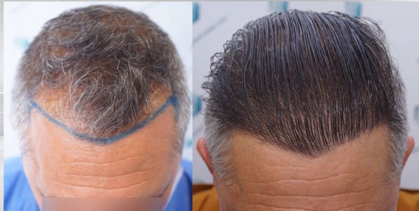 Injerto Capilar Técnica FUE Grafts 3712 (7455 Pelos) 115 127 COMPARATIVAS X