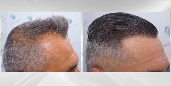 Injerto Capilar Técnica FUE Grafts 3712 (7455 Pelos) 116 128 COMPARATIVAS X