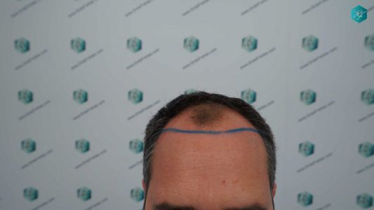 Injerto Capilar Técnica FUE Grafts 3289 (8464 Pelos) 8 13 DISENO LINEA INJERTO