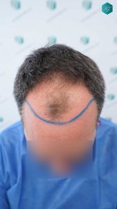 Injerto Capilar Técnica FUE Grafts 3289 (8464 Pelos) 9 14 DISENO LINEA INJERTO
