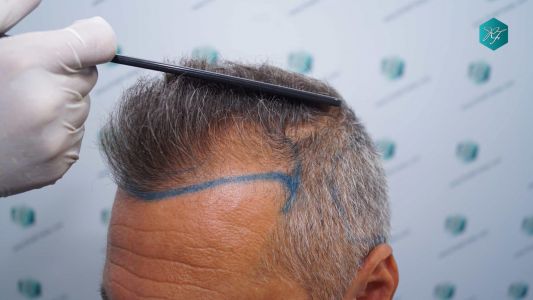 Injerto Capilar Técnica FUE Grafts 3712 (7455 Pelos) 13 15 DISENO LINEA DE INJERTO