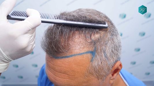 Injerto Capilar Técnica FUE Grafts 3712 (7455 Pelos) 14 16 DISENO LINEA DE INJERTO