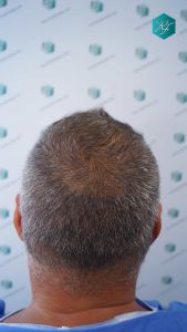 Injerto Capilar Técnica FUE Grafts 3712 (7455 Pelos) 15 17 DISENO LINEA DE INJERTO