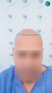 Injerto Capilar Técnica FUE Grafts 3289 (8464 Pelos) 10 17 DISENO LINEA INJERTO