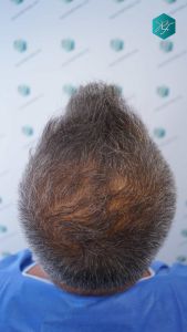 Injerto Capilar Técnica FUE Grafts 3712 (7455 Pelos) 16 18 DISENO LINEA DE INJERTO
