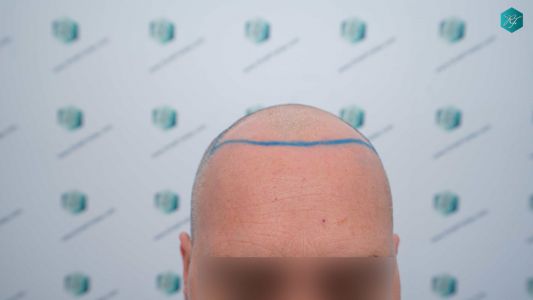 Injerto Capilar Técnica FUE Grafts 3289 (8464 Pelos) 11 18 DISENO LINEA INJERTO