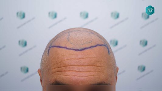 Injerto Capilar Técnica FUE Grafts 3712 (7455 Pelos) 17 19 DISENO LINEA DE INJERTO