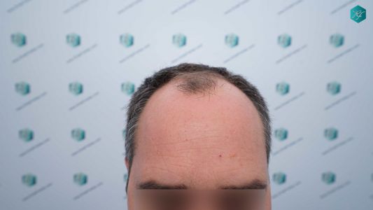 Injerto Capilar Técnica FUE Grafts 3289 (8464 Pelos) 1 2 ANTES DEL TRASPLANTE CAPILAR