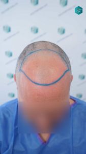 Injerto Capilar Técnica FUE Grafts 3289 (8464 Pelos) 12 20 DISENO LINEA INJERTO