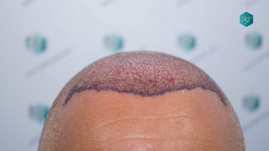 Injerto Capilar Técnica FUE Grafts 3712 (7455 Pelos) 18 21 TRASPLANTE CAPILAR