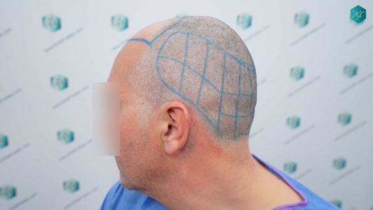Injerto Capilar Técnica FUE Grafts 3289 (8464 Pelos) 14 21B DISENO LINEA INJERTO