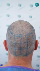 Injerto Capilar Técnica FUE Grafts 3289 (8464 Pelos) 15 23 DISENO LINEA INJERTO