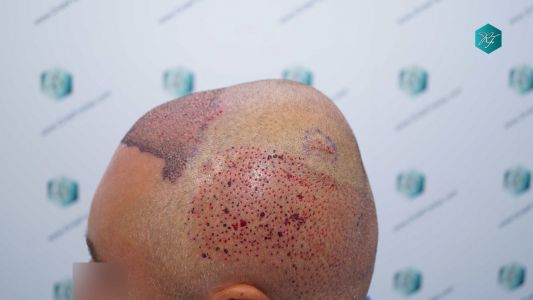 Injerto Capilar Técnica FUE Grafts 3712 (7455 Pelos) 24 28A ANTES DEL TRASPLANTE CAPILAR