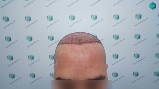 Injerto Capilar Técnica FUE Grafts 3289 (8464 Pelos) 16 29 TRASPLANTE CAPILAR