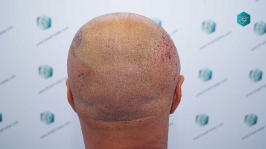 Injerto Capilar Técnica FUE Grafts 3712 (7455 Pelos) 26 29A ANTES DEL TRASPLANTE CAPILAR