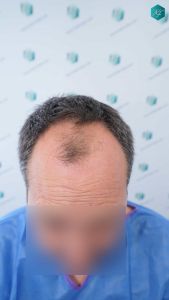 Injerto Capilar Técnica FUE Grafts 3289 (8464 Pelos) 2 3 ANTES DEL TRASPLANTE CAPILAR