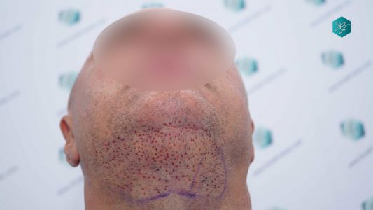 BHT EXTRACCIÓN 30 ANTES DEL TRASPLANTE CAPILAR