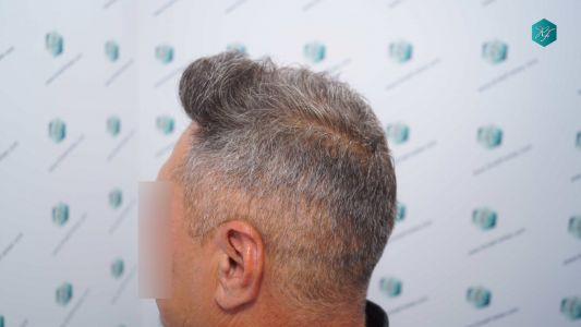 Injerto Capilar Técnica FUE Grafts 3712 (7455 Pelos) 30 30A EVOLUCION A LOS 12 MESES